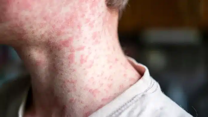 measles death outbreak texas